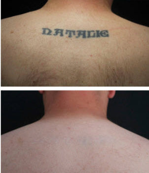 Before and After Tatoo Removal