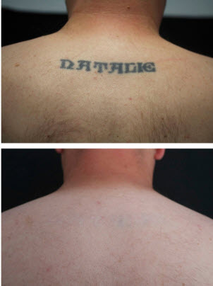 Before and After Tatoo Removal